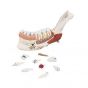 Advanced Half Lower Jaw with 8 diseased teeth 19 part VE290