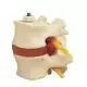 2 Lumbar Vertebrae with prolapsed disc A76/9