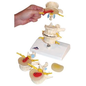 Stages of disc prolapse and vertebral degeneration A795