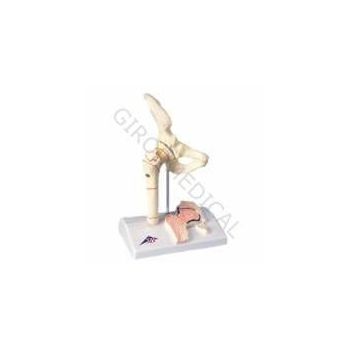 Femoral Fracture and Hip Osteoarthritis A88