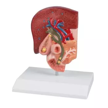 Gallstone Model Erler Zimmer