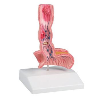 Oesophagus Diseases model Erler Zimmer