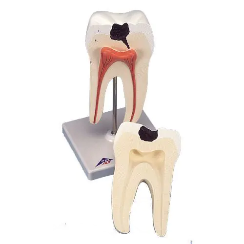 Lower Molar with double root and cavities D10/4