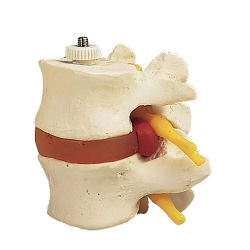 2 Lumbar Vertebrae with prolapsed disc A76/9