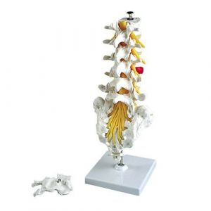 Lumbar Spinal Column with dorso-lateral prolapsed intervertebral disc A76/5